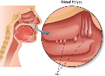 ริดสีดวงโพรงจมูก